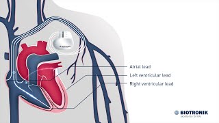 Cardiac Resynchronization Therapy – How it works [upl. by De Witt]