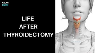 Life after Thyroidectomy [upl. by Machos]