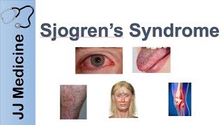 Sjogren’s Syndrome quotDry Eye Syndromequot  Primary vs Secondary Symptoms Diagnosis and Treatment [upl. by Leahciam]