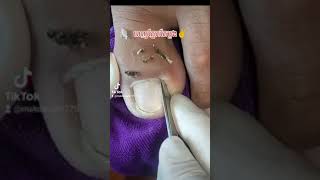 How nail insert into toe and remove without pain nail​​​ asmr fyp ear shorts viral wax [upl. by Nahoj]