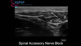 Ultrasound Guided Spinal Accessory Nerve Block [upl. by Eada923]