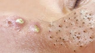 Big Cystic Acne Blackheads Extraction Blackheads amp Milia Whiteheads Removal Pimple Popping  1295 [upl. by Mccurdy]