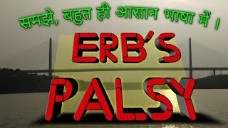 Erbs Palsy [upl. by Ripleigh]