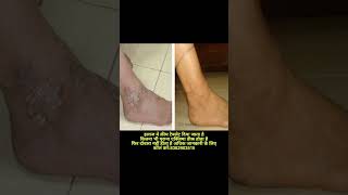 Eczema  Eczema treatment [upl. by Geri]