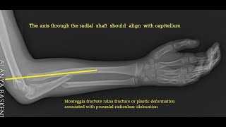 Monteggia Fracture and Equivalents [upl. by Conger]