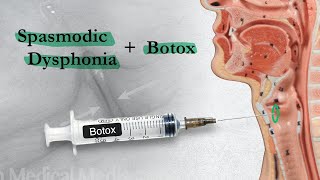 Spasmodic Dysphonia  When Botox Disappoints  Part 2 [upl. by Doti776]