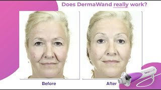 DermaWand Pro  Reduces Wrinkle Appearance in 1 WEEK Clinicallyproven radiofrequency device [upl. by Jessamyn]