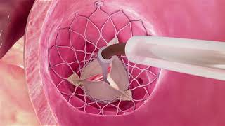 Transcatheter Aortic Valve Replacement [upl. by Swerdna]