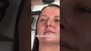 Botox brow lift injection points [upl. by Ettie]