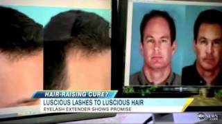 Latisse for Scalp Hair GrowthGood Morning AmericaABC [upl. by Randy]