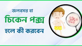 চিকেন পক্স বা বসন্ত হলে যা করবেন  Get Rid of Chicken Pox FAST  Heres the Secret [upl. by Jestude]