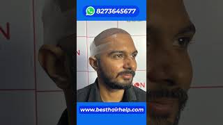 6 Months Hair Transplant Result Journey In 1 Minute 🔥🔥🔥 hairtransplantresults [upl. by Annadal]