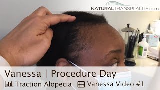 Hereditary Hair Loss in Female  Hair Transplant  Dr Kevin Blumenthal Vanessa [upl. by Namie335]