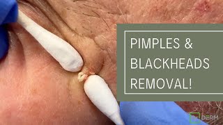 Pimples and Blackheads Removal  Dr Derm [upl. by Eiramlatsyrk]