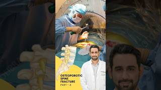 Treatment of Osteoporotic spine fracture  Dr Dheeraj Batheja  Part 2 doctor spinehealth [upl. by Daniyal]