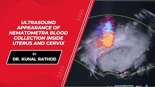 Ultrasound appearance of hematometra blood collection inside uterus and cervix  Dr Kunal Rathod [upl. by Leemaj727]