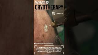 What is Cryotherapy Cryoablation or Cryosurgery medical mole skintreatment skin cryo [upl. by Ahsoet122]