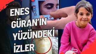 ENES GÜRAN’IN YÜZÜNDEKİ İZLERİN NEDENİ [upl. by Mahla]