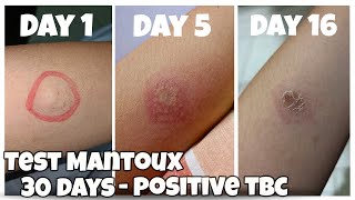 Before After 30 Days Test Mantoux  Positive Tuberculosis TBC [upl. by Lebasiram796]