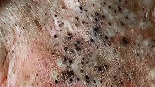 Big Cystic Acne Blackheads Extraction Blackheads amp Milia Whiteheads Removal Pimple Popping 04 [upl. by Deedee]