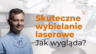 Wybielanie zębów skuteczne jak wygląda wybielanie laserowe Opowiada Queen of smile [upl. by Nerol]