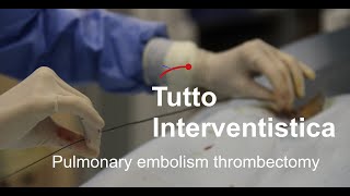 Pulmonary embolism thrombectomy [upl. by Ethan]