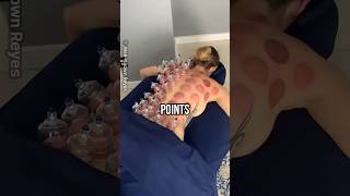 Cupping Therapy for Fatigue Recovery [upl. by Sevik]