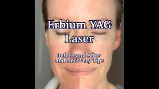 Erbium YAG Laser Treatment  Results and PostCare [upl. by Coad]