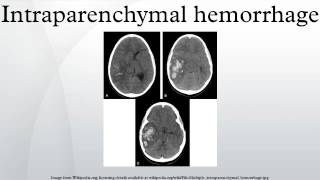 Intraparenchymal hemorrhage [upl. by Cirtemed638]