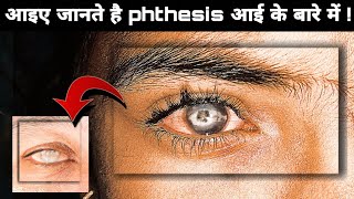 क्या आप जानते है Phthisis eye के बारे में  phthisis eye in Hindiphthisis eye  phthisis bulbi eye [upl. by Terrag938]