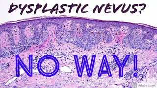 Melanoma Lentigo Maligna Type vs Dysplastic Nevus 5Minute Pathology Pearls [upl. by Scrogan]