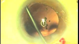 Perfect Capsulotomy Part 1 Femtosecond Laser vs Fugo Plasma Blade [upl. by Hasin169]