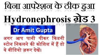 Cured case of Hydronephrosis Grade3 Homoeopathy did magic in Hydronephrosis [upl. by Ludwig499]