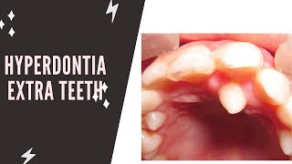 Hyperdontia Extra teeth  supernumerary teeth [upl. by Bette]