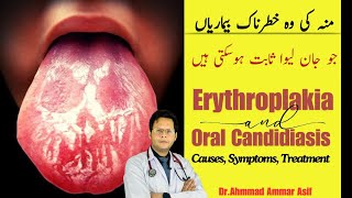 What Is Erythroplakia amp Oral Candidiasis  Causes Symptoms Treatment [upl. by Howarth]