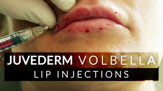 Lip Filler Juvederm Volbella Treatment [upl. by Inanaup]