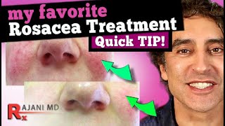 FACE FLUSHING TREATMENT  MY FAVORITE ROSACEA TREATMENT  Rosacea Cure [upl. by Namzed]