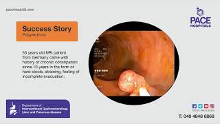 Polypectomy for 55 years male suffering with chronic constipation since 10 years PaceHospitals [upl. by Luke215]