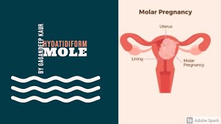 HYDATIDIFORM MOLE Unit7 OBG HIGH RISK PREGNANCY [upl. by Sibley]