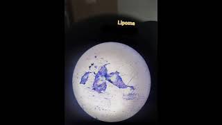 Lipoma case pathology cytology smear medicalswelling [upl. by Lenra954]