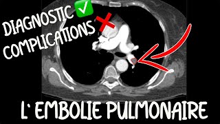 Radiologie  Lembolie pulmonaire pour lEDN  bases pour tout médecin [upl. by Floridia502]