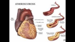 The Truth about Statins Cholesterol and Heart Disease  part 1 [upl. by Trace]