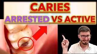 How to Differentiate between Arrested and Active CARIES Clinical Cases caries removal ICDAS [upl. by Rekrap728]