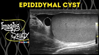 Epididymal Cyst  Ultrasound  Case 51 [upl. by Gall]