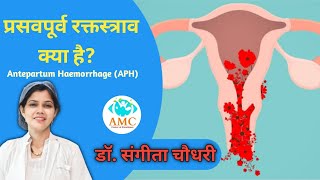 प्रसवपूर्व रक्तस्त्राव क्या है Antepartum Haemorrhage APH drsangitachaudhary [upl. by Alejandra]