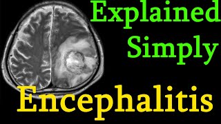 Encephalitis  brain inflammation  Symptoms causes prognosis Treatment explained simply [upl. by Suilenrac]