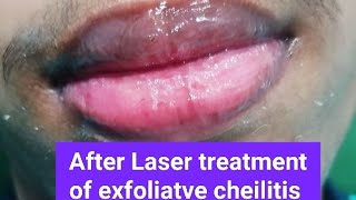 Two cases of exfoliatve cheilitis treated by Laser excellent response [upl. by Loats144]