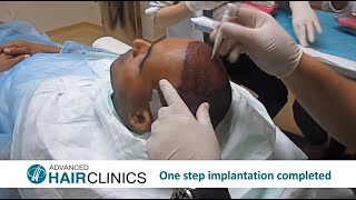 FUE Hair Transplantation StepbyStep by Dr Anastasios Vekris [upl. by Curr]