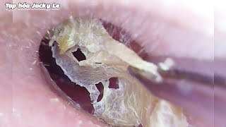 Ear Wax Removal 124 This Is My First Time Getting My Ears Cleaned  Ear Cleaning ASMR [upl. by Ahsilet]