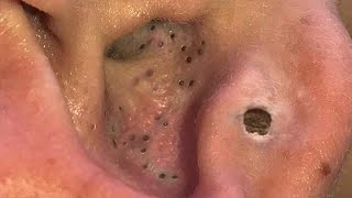 Big Cystic Acne Blackheads Extraction Blackheads amp Milia Whiteheads Removal Pimple Popping  3913 [upl. by Ahsenit106]